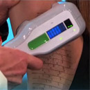 MiraDry: New Solution to Excessive Sweating